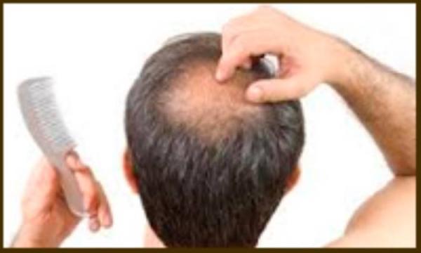 ویتامین ها برای پیشگیری از ریزش مو در زنان